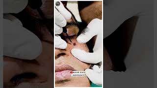 Safe Mole Removal StepbyStep Procedure and Aftercare Guidequot Awish Clinic [upl. by Leinaj]