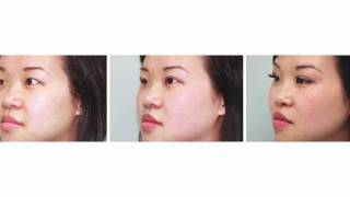 Double Eyelid Surgery Seeing Final Results  Dr Buonassisi 8 West Clinic in Vancouver BC [upl. by Delos]