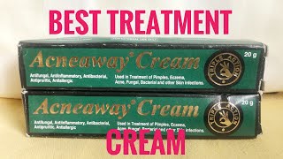 Acneaway Cream ReviewBest Treatment Cream For Fungi Fungal Treatment [upl. by Ace]