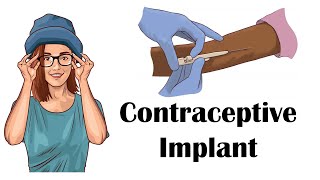 Contraceptive Progesterone Implant  Uses Mechanism Of Action Adverse Effects Contraindications [upl. by Misaq915]