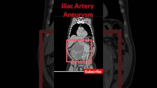 iliac artery aneurysm  Cect Abdomen shorts iliacarteryaneurysm cectabdomen radiology [upl. by Berglund]