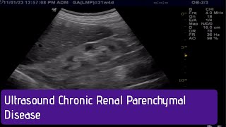 Ultrasound  How to Diagnose Chronic Renal Parenchymal Disease [upl. by Dudley]