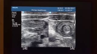 Intussusception Ultrasound short clip and image [upl. by Enyamrahc]