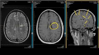 ADC Positive Multiple Sclerosis  Demyelination MRI Case Review [upl. by Yousuf]