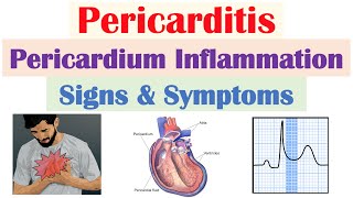 Pericarditis Pericardial Inflammation Signs amp Symptoms amp Why They Occur [upl. by Burk508]