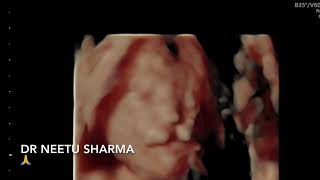 Ultrasound  Twin Pregnancy 1 abnormal twinpregnancy pregnancy indore [upl. by Nsaj]