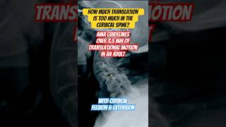 Cervical Instability doctor chiropractic radiology [upl. by Amesari]