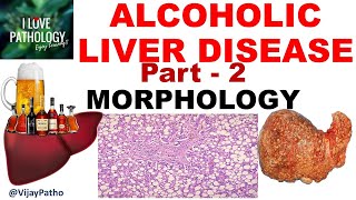 ALCOHOLIC LIVER DISEASE Part 2 Morphology Clinical Features amp Complications including cirrhosis [upl. by Anissa]