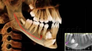 ODONTOMA ASOCIADO A CANINO RETENIDO [upl. by Hutchings]