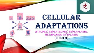 Cellular AdaptationsAtrophyHypertrophyHyperplasiaMetaplasia DysplasiaPathophysiologyHindi [upl. by Noivad]