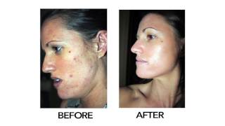 The Perfect Derma Peel [upl. by Merdith]