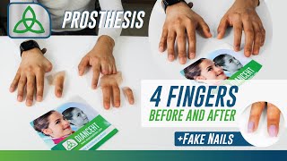 DIANCEHT  4 Finger Prosthesis amp Fake Nail Application [upl. by Retsam]