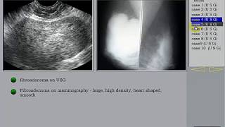 Breast Ultrasound Part 2 Fibroadenoma [upl. by Ydnew677]