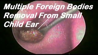 Multiple Foreign Bodies Removal From Small Child Ear [upl. by Anilrac]