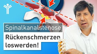 Rückenschmerzen durch Spinalkanalstenose richtig behandeln  Wann operieren [upl. by Haslam]