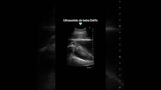 Ultrasonido de bebe Delfín 🐬 [upl. by Laddy]