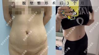 3 months after abdominal plastic surgery [upl. by Soll267]