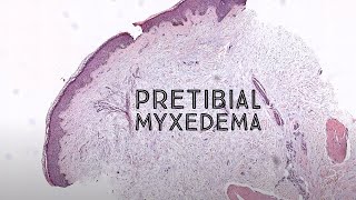 Pretibial myxedema Graves disease thyroid dermopathy pathology dermpath dermatology USMLE [upl. by Yle]