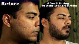 5thPart Acne Scar Treatmentक्या सच में Pimples के गड्डो का इलाज़ करवाने से Acne Scar ठीक हो जाते है [upl. by Ellenuahs]