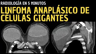 Radiología en 5 minutos Linfoma anaplásico de células gigantes [upl. by Lorraine465]