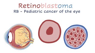 Retinoblastoma [upl. by Clyde]