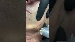 Plasma plasma skintightening [upl. by Samy]