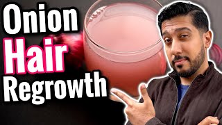 Onion Juice for Hair Growth  REGROW Hair With Onion Juice [upl. by Estevan997]