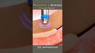 peyronies disease treatment shorts viral disease peyronies [upl. by Natsyrk]