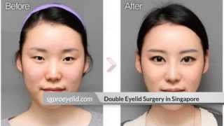 Double Eyelid Surgery Singapore [upl. by Laban435]