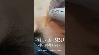 레이저 흑자 제거 치료 시술 가격 비싼 리팟레이저 아니여도 깨끗하게 제거 가능lentigo laser removal [upl. by Oijres]