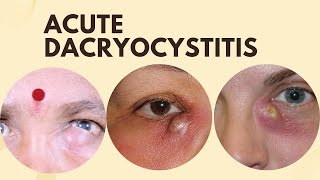 Acute Dacryocystitis [upl. by Siloam]