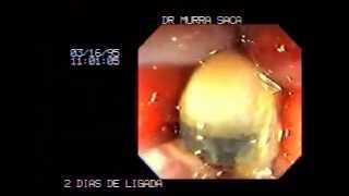 Video Hemorrhoids rubber band ligation 2 [upl. by Sivat]