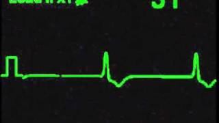 Idioventricular Rhythm  ECG Simulator  Arrhythmia Simulator [upl. by Htebaile]