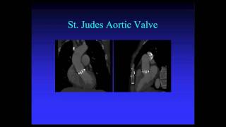 CT Imaging of Aortic Valve Part 1 [upl. by Oby]