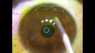 PRK NORMALIZATION WAVEFRONT GUIDED  ACELERATED quotHIGHFLUENCEquot AVEDRO CORNEAL CROSSLINKING KXL [upl. by Annayram]