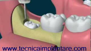 estrazione del dente del giudizio in inclusione ossea totaleflv [upl. by Llenehc]