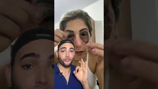 Peeling de Fenol en el contorno de Los ojos skincare beauty [upl. by Simonsen]