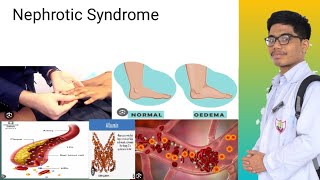 Nephrotic Syndrome  Signs and Symptoms of Nephrotic Syndrome [upl. by Magee766]