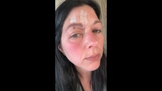 Postherpetic Neuralgia of the Face  A Young Mothers Story [upl. by Wexler505]