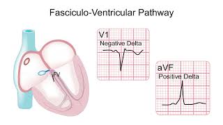 How to Recognize Atypical Pathways During Sinus Rhythm [upl. by Varney766]