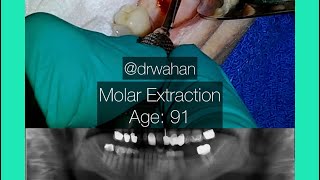 Molar Extraction with Cowhorn Forceps Age 91 [upl. by Jobye275]