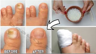 Cure toenail Fungus for less than 1 Do you have nail fungus You have to do it [upl. by Margarethe161]