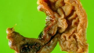 Meckels diverticulum  Pathology mini tutorial [upl. by Aharon]