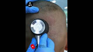 Best Hair Transplant Technique in India ifthairscience hairtransplantclinic iftclinic [upl. by Namurt860]