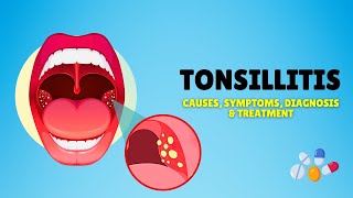 Tonsillitis – Causes Signs and Symptoms Diagnosis amp Treatment [upl. by Frederigo]