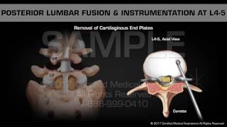 Posterior Lumbar Fusion amp Instrumentation at L45 [upl. by Eerb104]