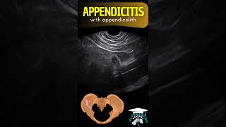 Diagnosing Appendicitis in Young Adults Ultrasound Case Study ultrasound appendicitis [upl. by Laitselec]