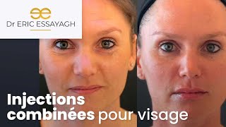 Combinaison dinjections pour le visage avec lEssayagh Butterfly Concept™ [upl. by Bolling480]