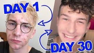 How I Cleared My Acne Scars in 30 Days [upl. by Omlesna509]