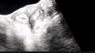 Bicornuate uterus on Ultrasound [upl. by Hoy]